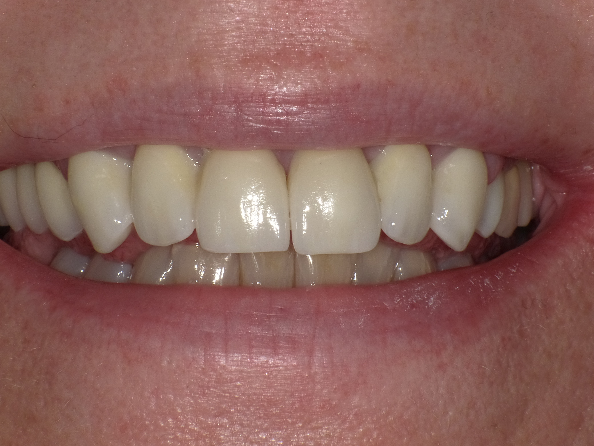 Korrektur in Sedierung in nur zwei Terminen mit Vollkeramik